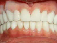 After - Wiltondental